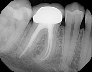 Root Canal Treatment